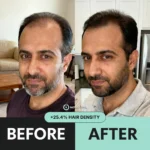 NovaMane™ Hair Regrowth 2.0 Adenosine & GHK-Cu Micro-Infusion System - Image 3