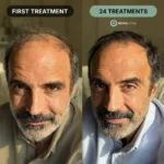 NovaMane™ Hair Regrowth 2.0 Adenosine & GHK-Cu Micro-Infusion System - Image 6