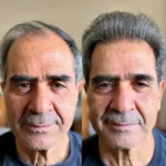NovaMane™ Hair Regrowth 2.0 Adenosine & GHK-Cu Micro-Infusion System - Image 8