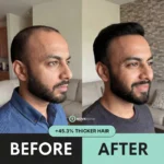 NovaMane™ Hair Regrowth 2.0 Adenosine & GHK-Cu Micro-Infusion System - Image 10